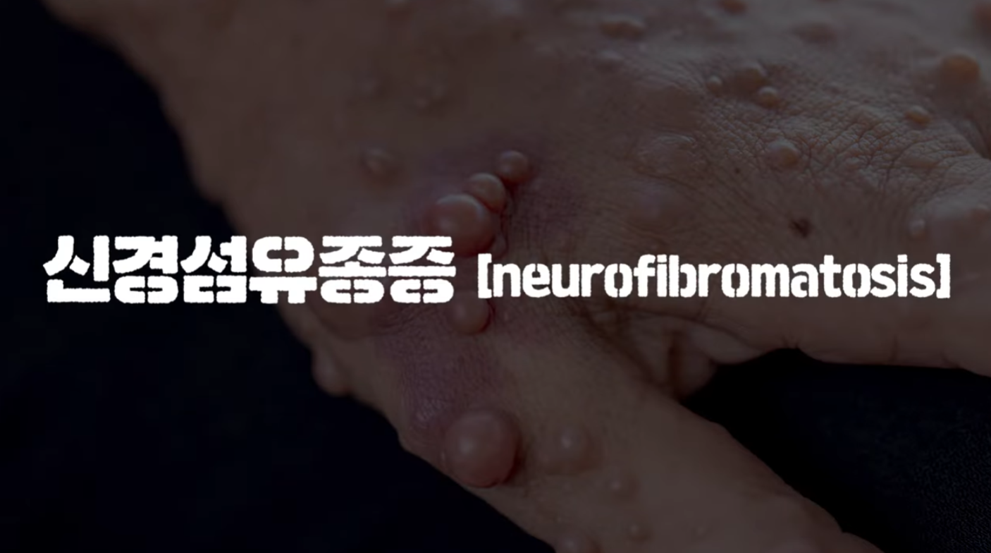 신경섬유종
